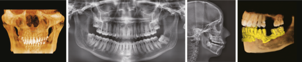 Компьютерный томограф стоматологический Green X